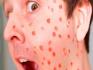 Chickenpox