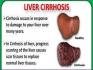 Liver Cirrhosis