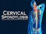 Cervical Spondylosis